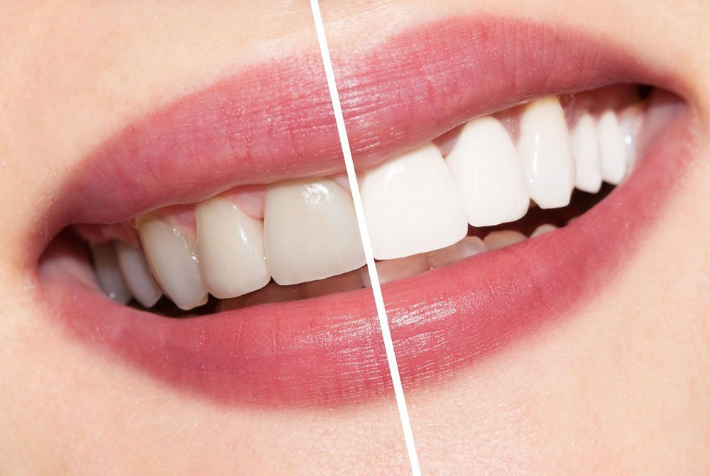 Permanent Teeth Whitening Options in Mesa, Arizona - Top Rated Cosmetic & General  Dentist in Mesa AZ 85203