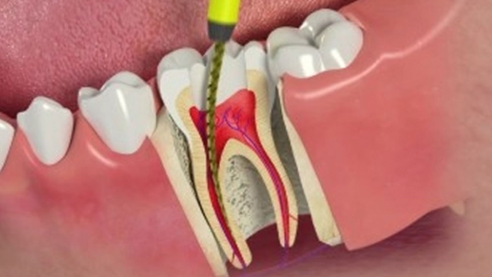 5 Root Canal Myths Exposed Eastport Dental Mesa Arizona Dentist