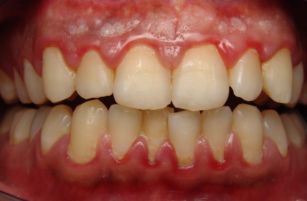 white gum infection