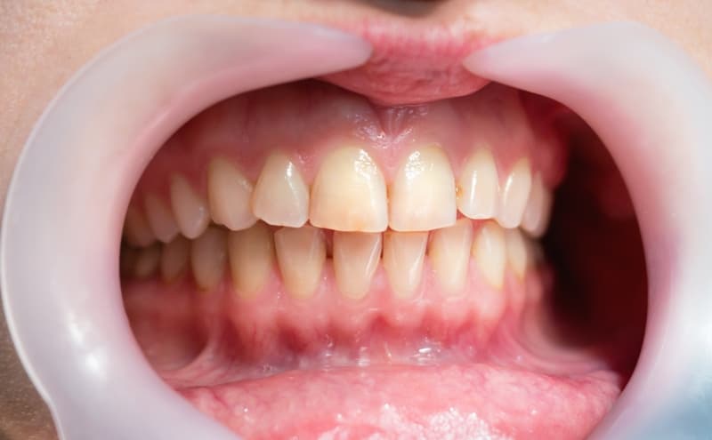 what-is-the-main-cause-of-gum-disease