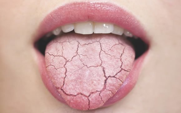 dry-mouth-causes-symptoms-side-effects-treatments-top-rated