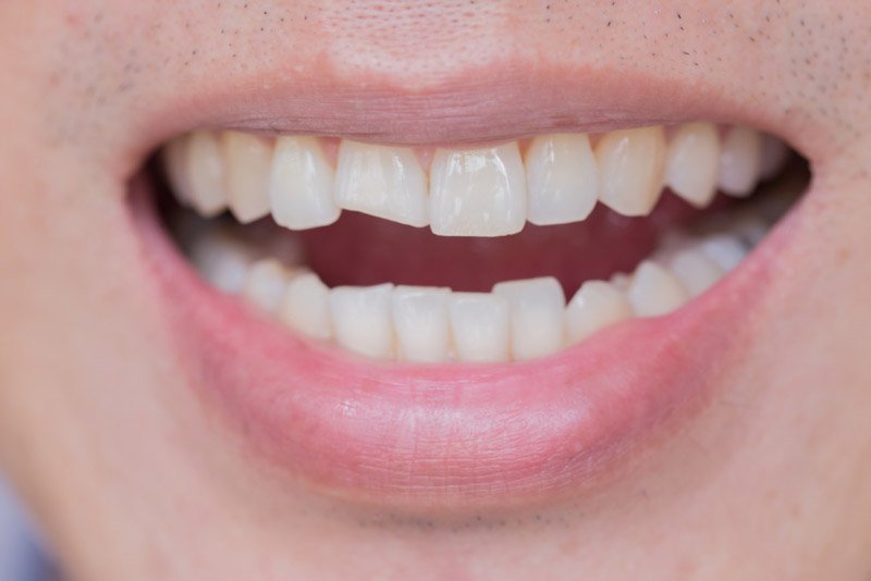 How to fix a chipped front tooth