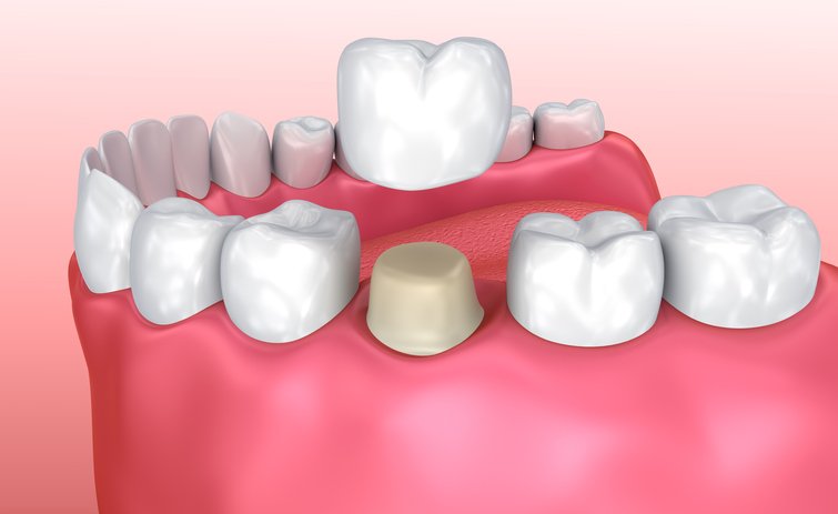 veneers vs crowns