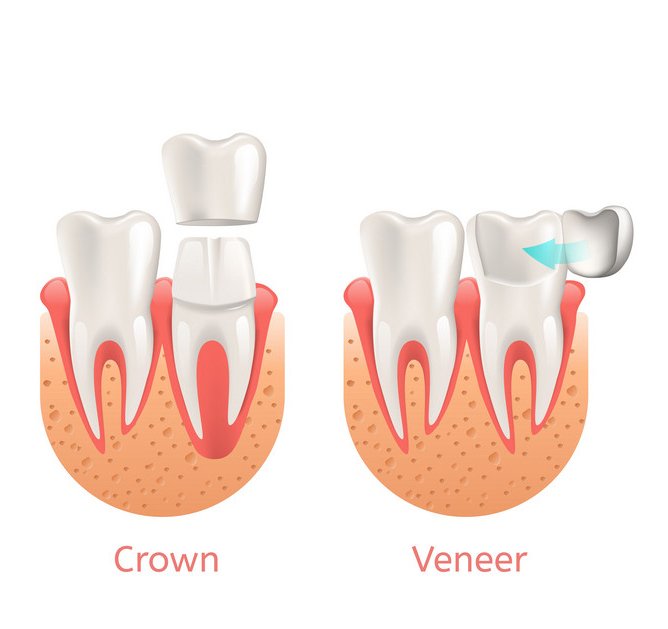 veneers vs crowns