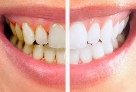 how to remove baby teeth tartar