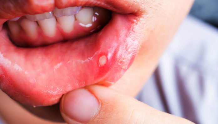 Inside store mouth blister