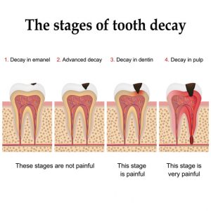 do cavities cause pain