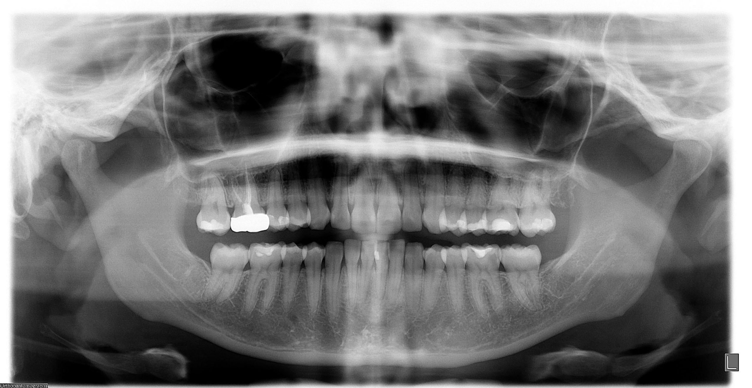 impacted teeth xray