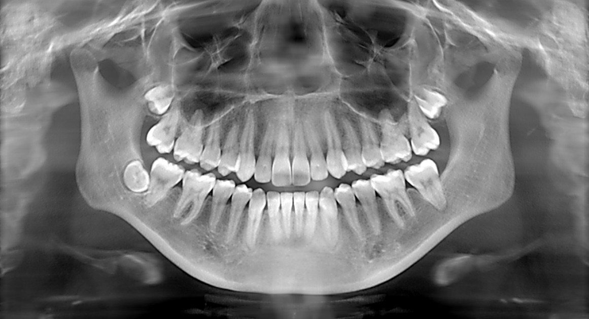 abscessed tooth xray