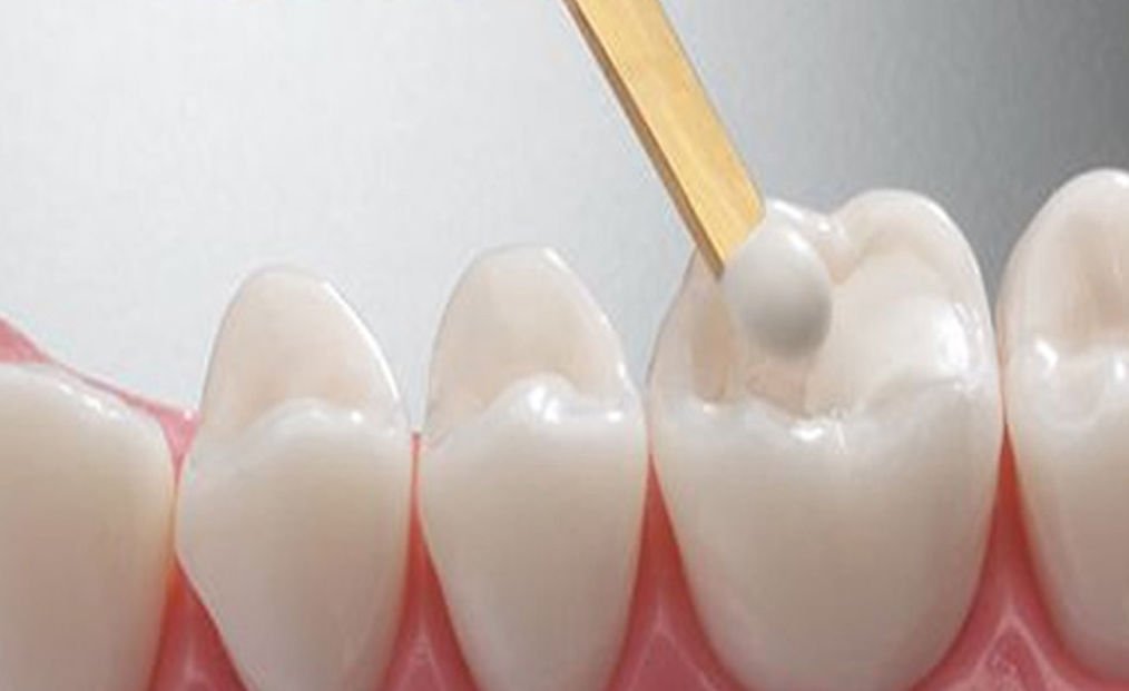 dental fillings