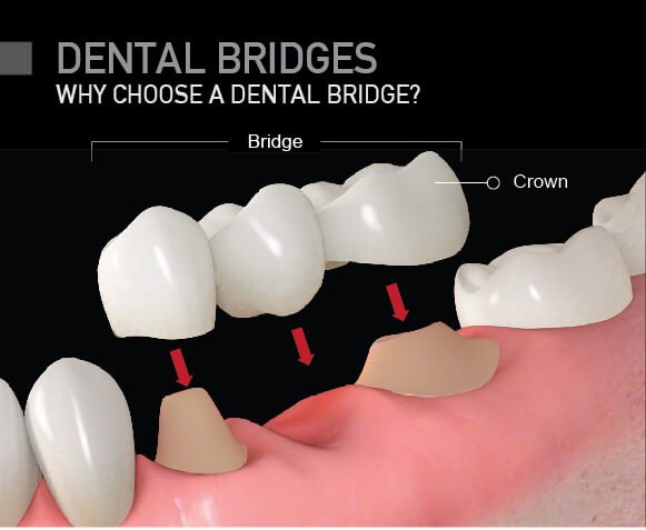 dental bridges vs implants