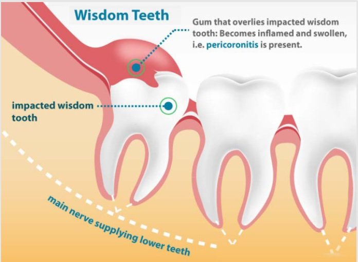 wisdom-tooth-infection-Mesa-AZ