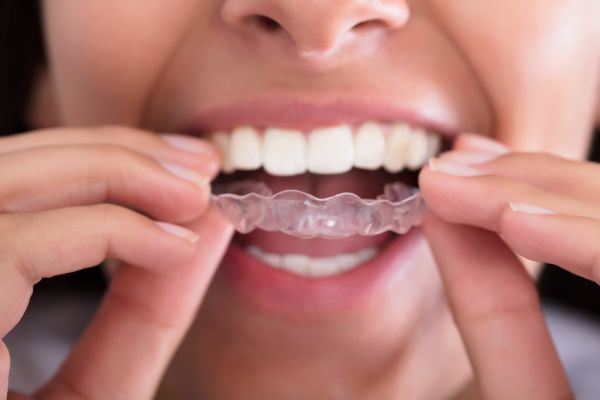 Common Types of Mouth Guards and Bite Splints - Top Rated Cosmetic